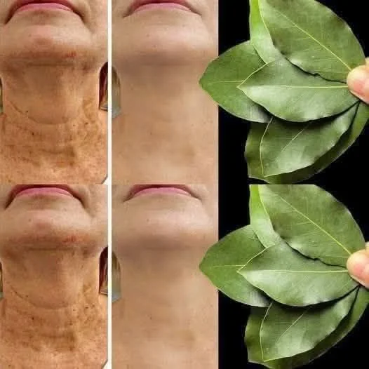 Bay leaf is 100,000 times stronger than Botox. It erases all wrinkles even at the age of 70.