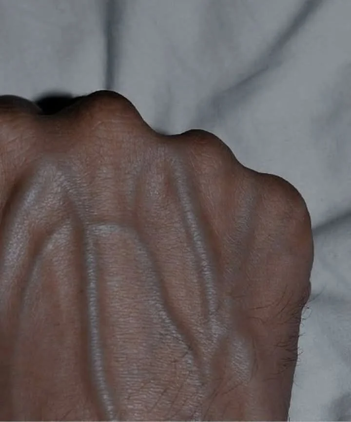 If your veins are visible in your hand, it is a signal of ca... See more